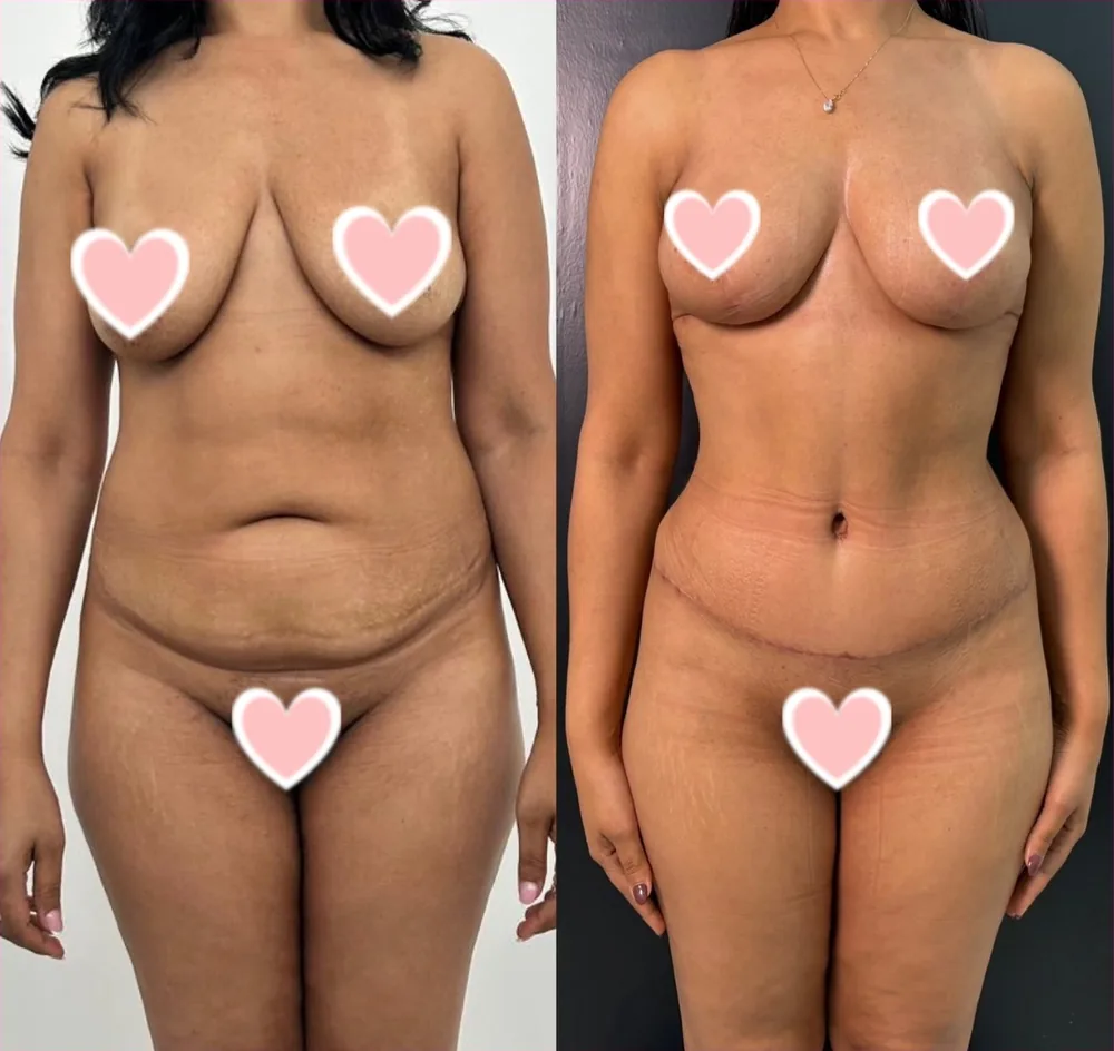 Abdominoplastia e Mastopexia