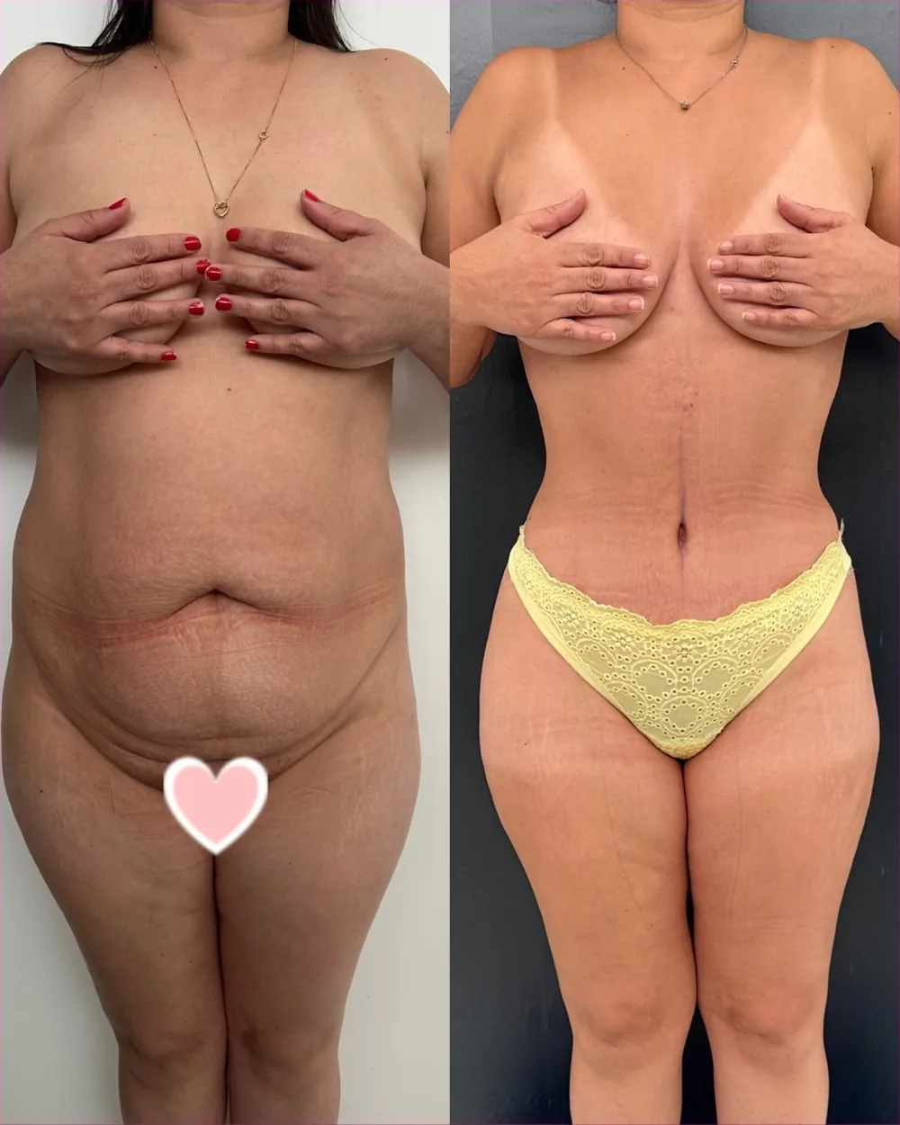 Abdominoplastia
