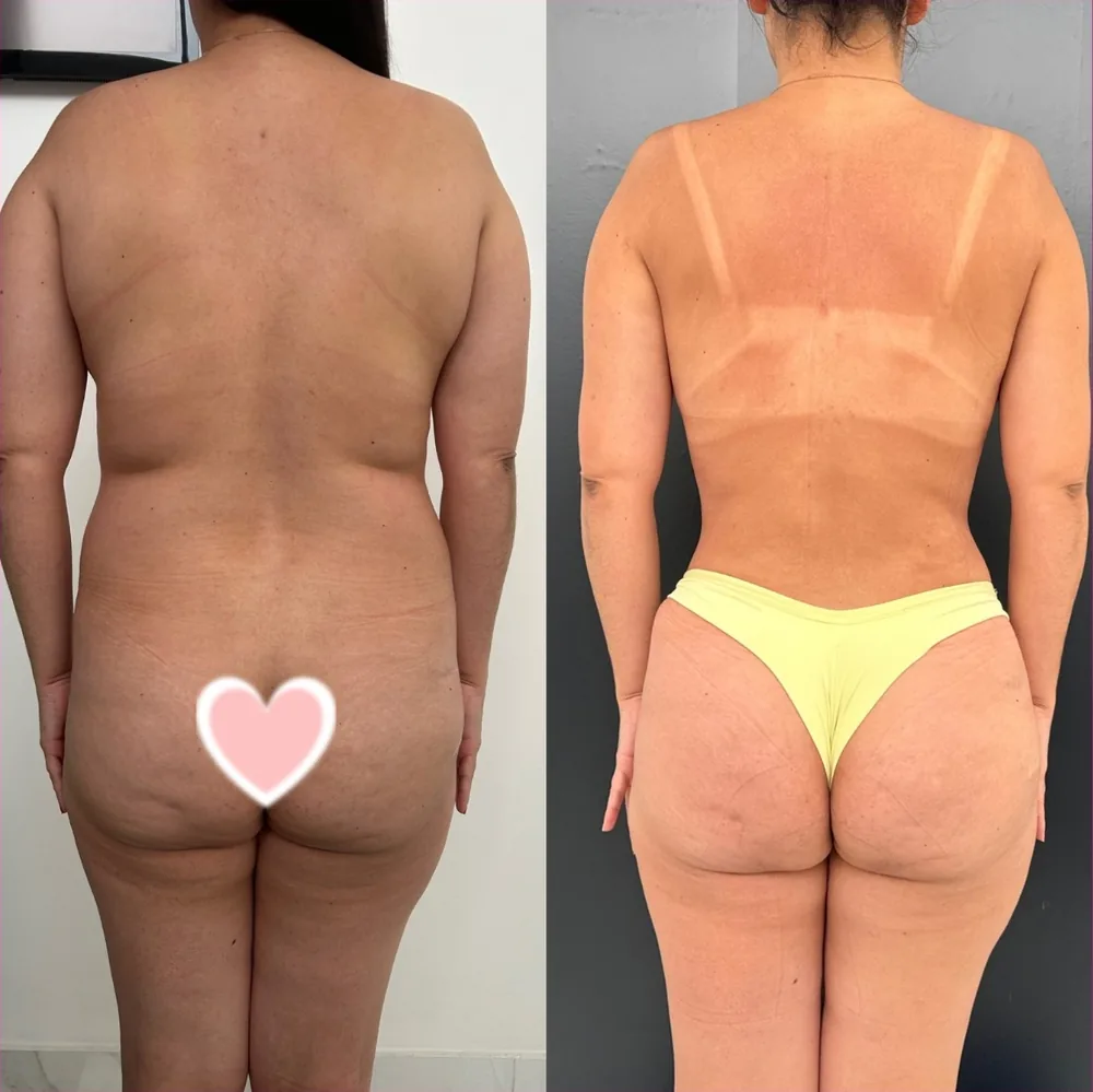 Mommy Makeover, contorno posterior